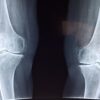 knee x ray medical anatomy 2253047