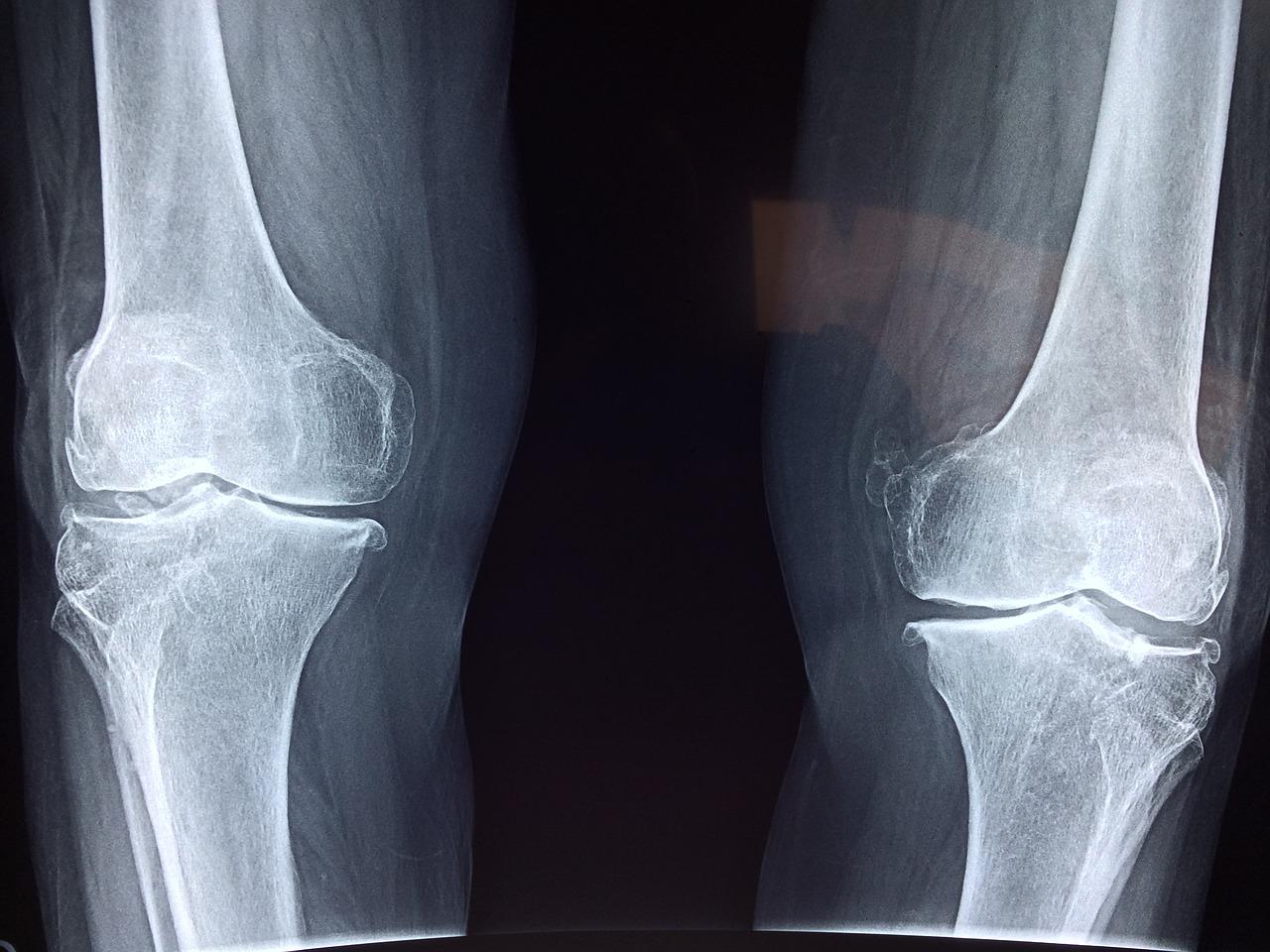 knee x ray medical anatomy 2253047